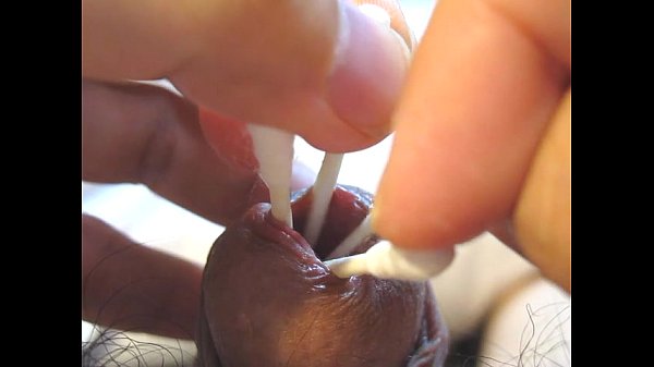 Insert the cotton swab into the urethra and spread peehole
